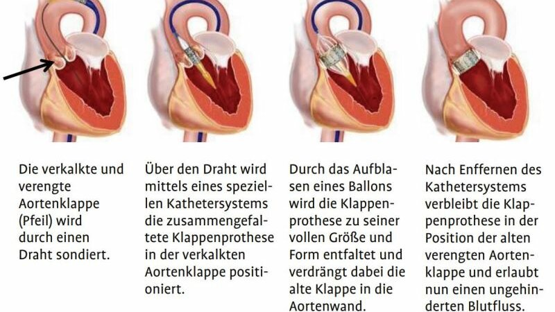 Foto: Herzklappenersatz - TAVI für alle? (Quelle: Flyer HERZ ZENTRUM WESTFALEN)